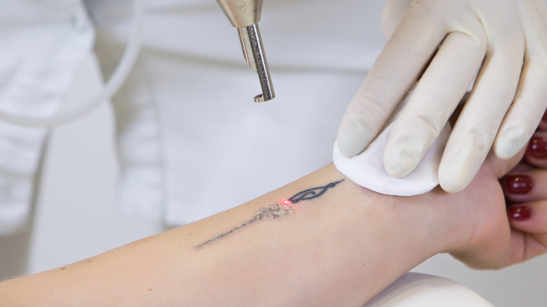 Ștergere tatuaj