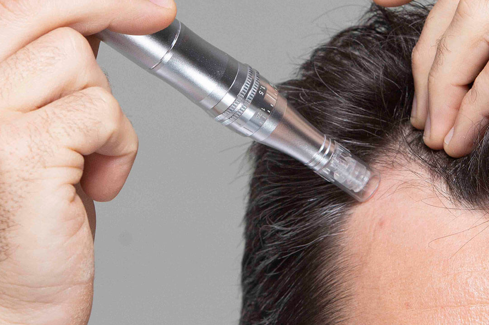 Microneedling pentru scalp